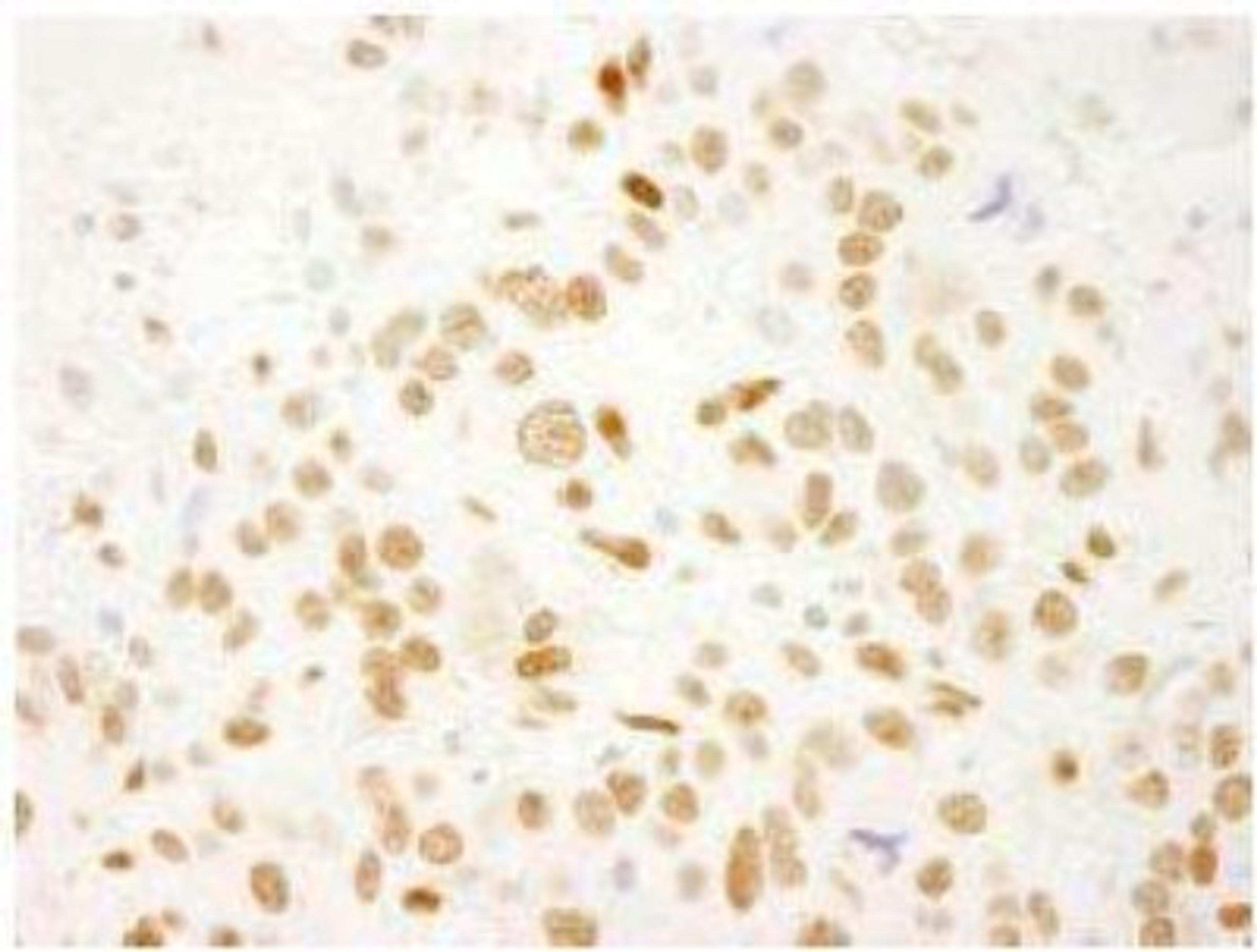 Immunohistochemistry-Paraffin: QKI/Quaking Antibody [NB300-240] - FFPE section of human breast carcinoma.  Affinity purified rabbit anti-QKI used at a dilution of 1:250.