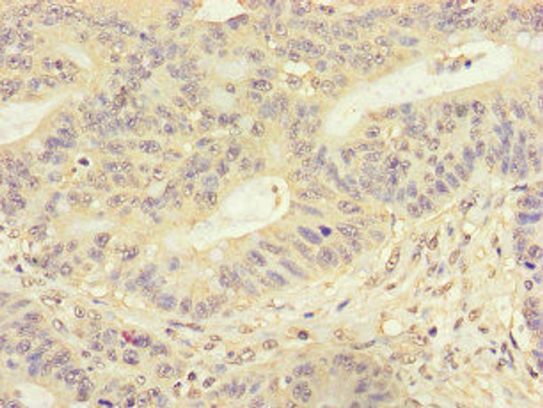 Immunohistochemistry of paraffin-embedded human colon cancer using CSB-PA815554LA01HU at dilution of 1:100