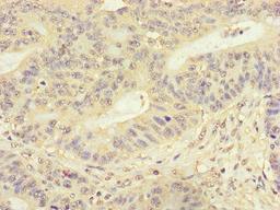 Immunohistochemistry of paraffin-embedded human colon cancer using CSB-PA815554LA01HU at dilution of 1:100