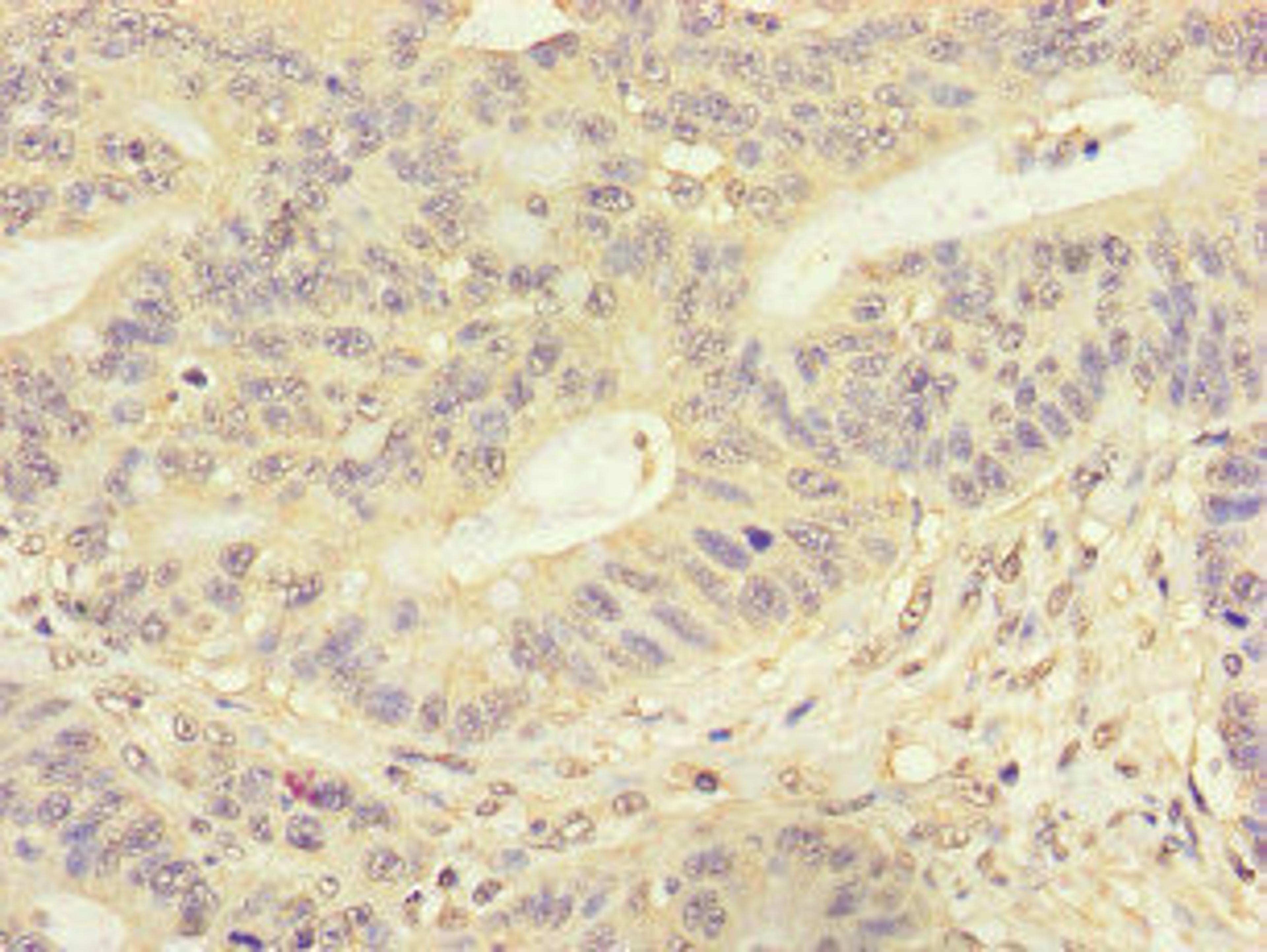 Immunohistochemistry of paraffin-embedded human colon cancer using CSB-PA815554LA01HU at dilution of 1:100