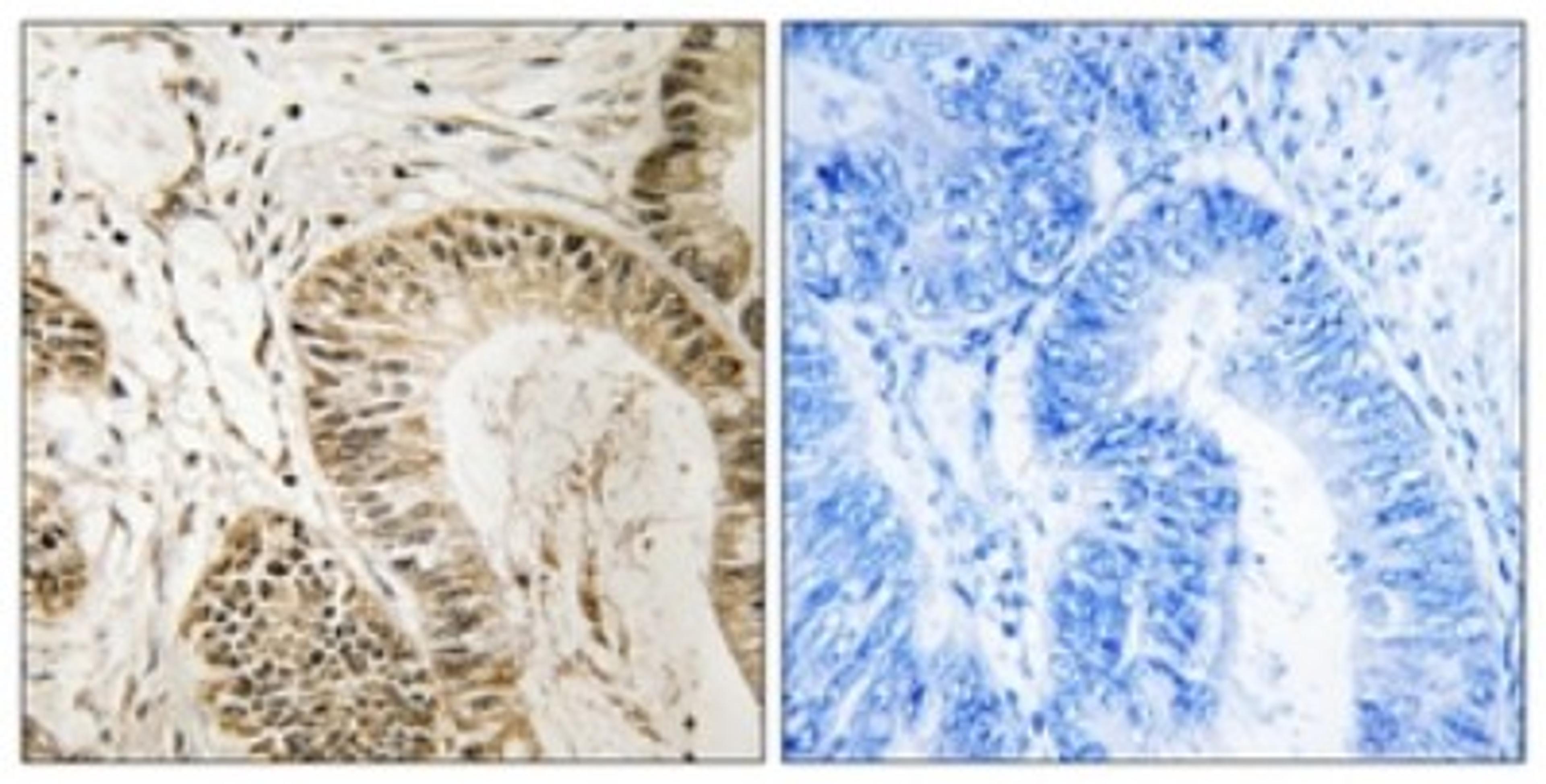 Immunohistochemistry-Paraffin: RGS1 Antibody [NBP1-68645] - Analysis of paraffin-embedded human colon carcinoma tissue, using RGS1 Antibody. The picture on the right is treated with the synthesized peptide.