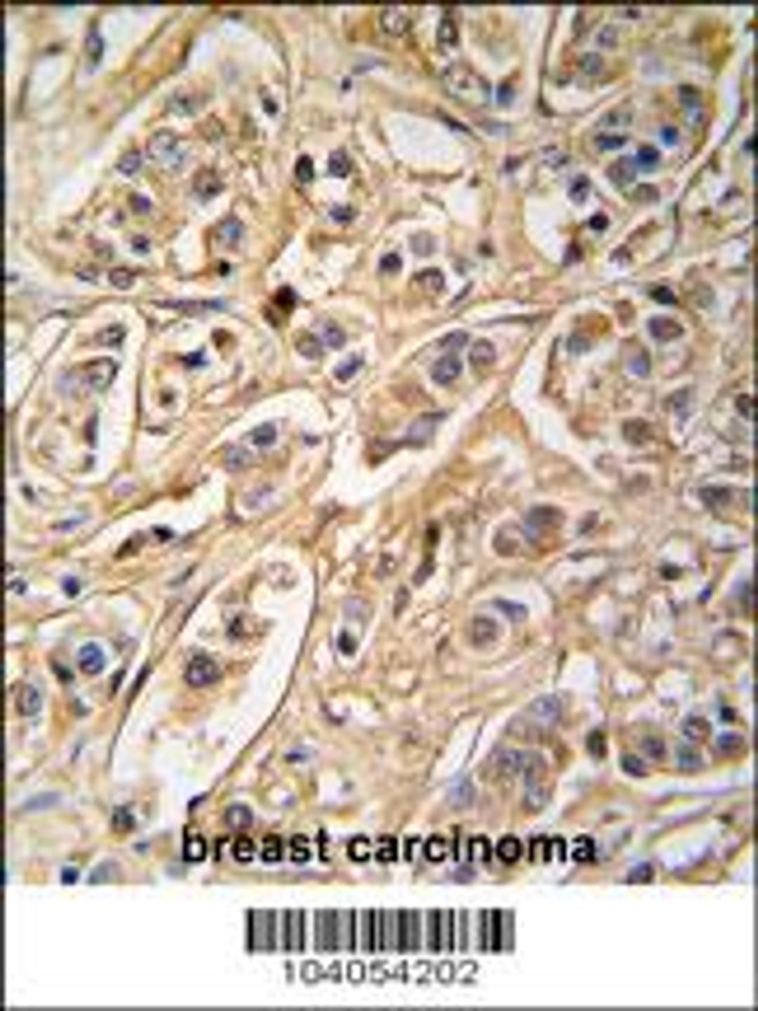 Formalin-fixed and paraffin-embedded human breast carcinoma tissue reacted with 14-3-3 protein zeta/delta antibody , which was peroxidase-conjugated to the secondary antibody, followed by DAB staining.