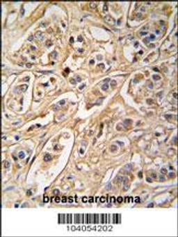 Formalin-fixed and paraffin-embedded human breast carcinoma tissue reacted with 14-3-3 protein zeta/delta antibody , which was peroxidase-conjugated to the secondary antibody, followed by DAB staining.