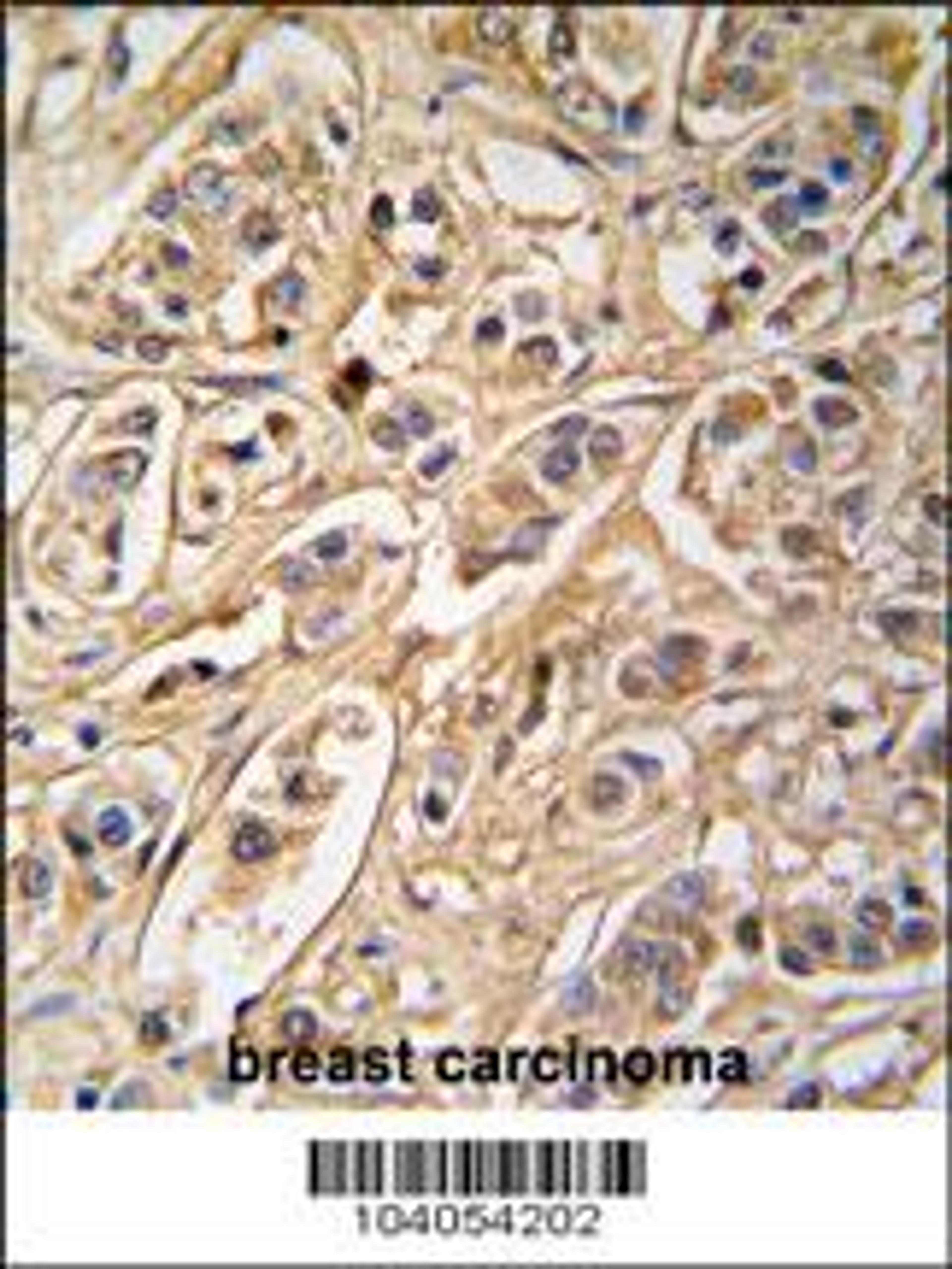 Formalin-fixed and paraffin-embedded human breast carcinoma tissue reacted with 14-3-3 protein zeta/delta antibody , which was peroxidase-conjugated to the secondary antibody, followed by DAB staining.