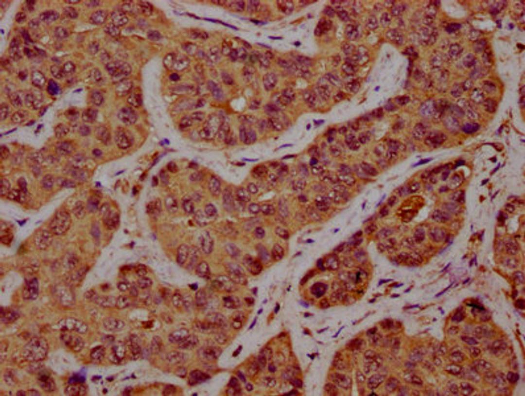 IHC image of CSB-PA837881LA01HU diluted at 1:300 and staining in paraffin-embedded human liver cancer performed on a Leica BondTM system. After dewaxing and hydration, antigen retrieval was mediated by high pressure in a citrate buffer (pH 6.0). Section was blocked with 10% normal goat serum 30min at RT. Then primary antibody (1% BSA) was incubated at 4°C overnight. The primary is detected by a biotinylated secondary antibody and visualized using an HRP conjugated SP system.