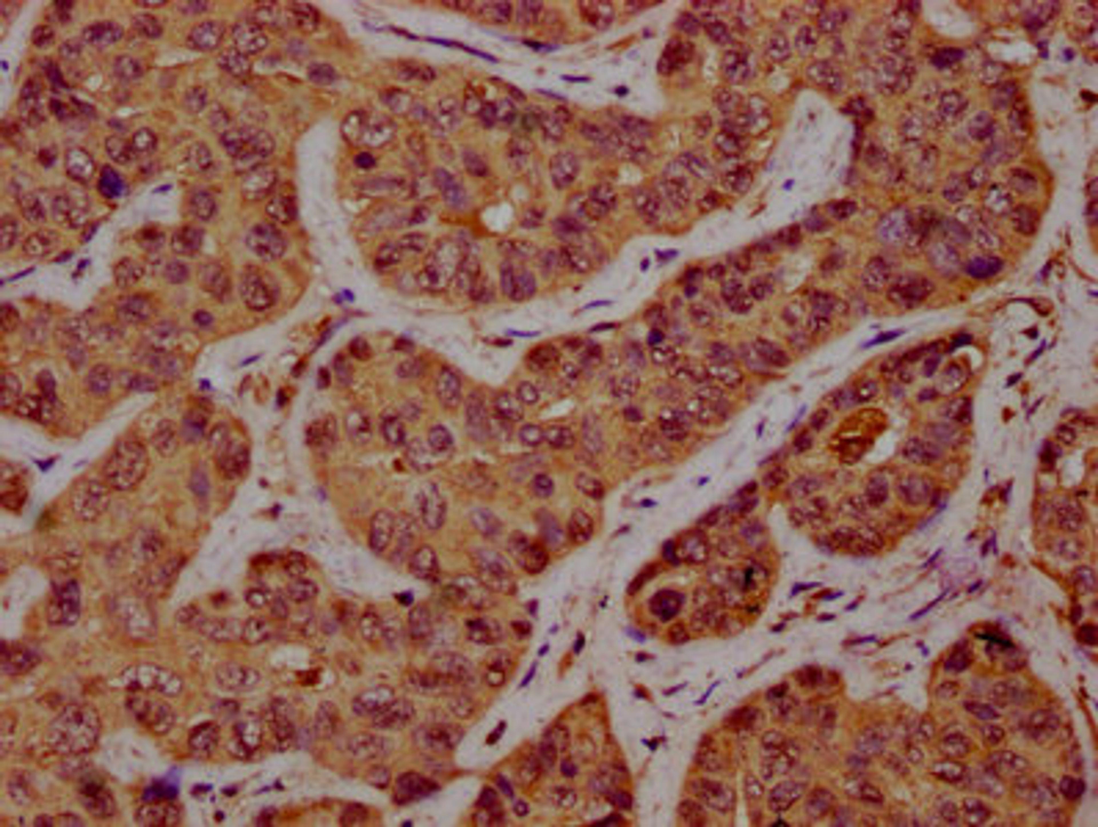 IHC image of CSB-PA837881LA01HU diluted at 1:300 and staining in paraffin-embedded human liver cancer performed on a Leica BondTM system. After dewaxing and hydration, antigen retrieval was mediated by high pressure in a citrate buffer (pH 6.0). Section was blocked with 10% normal goat serum 30min at RT. Then primary antibody (1% BSA) was incubated at 4°C overnight. The primary is detected by a biotinylated secondary antibody and visualized using an HRP conjugated SP system.