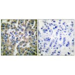 Immunohistochemical analysis of paraffin-embedded human breast carcinoma tissue using HSP10 antibody.