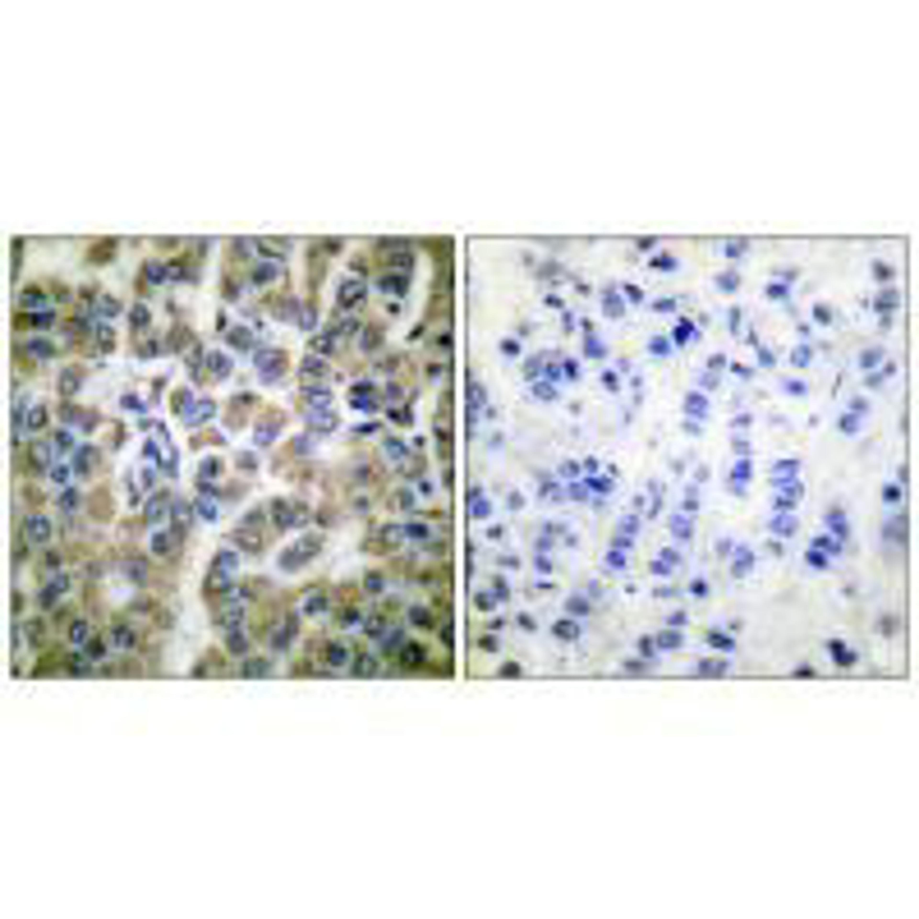Immunohistochemical analysis of paraffin-embedded human breast carcinoma tissue using HSP10 antibody.
