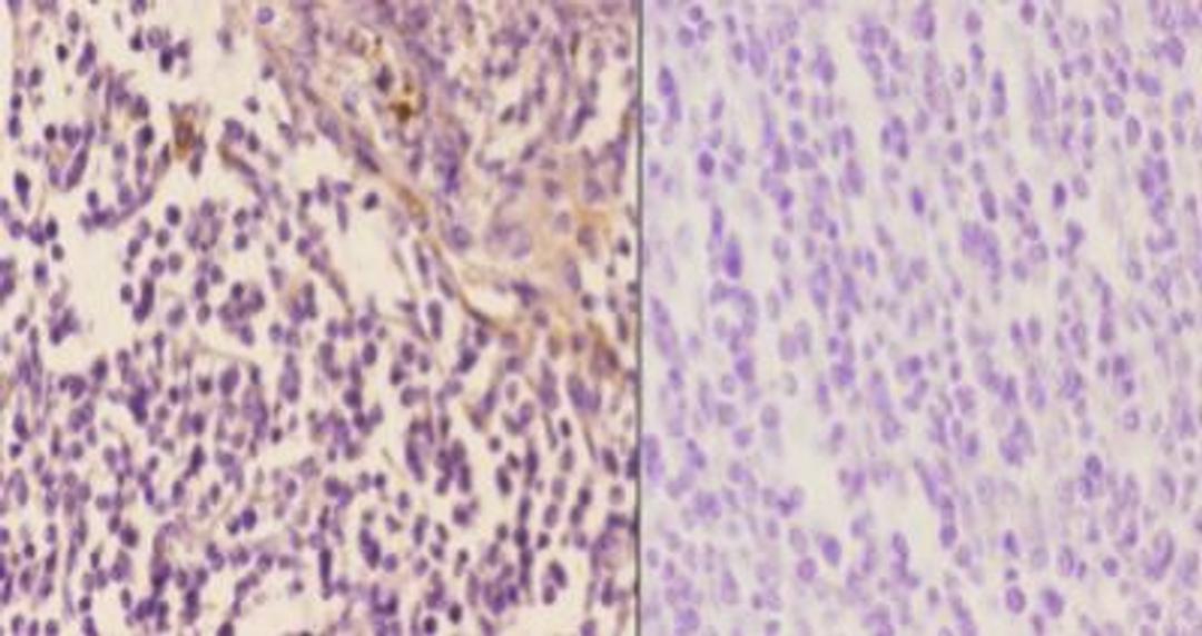 Immunohistochemistry-Paraffin: Arrestin 3 Antibody [NBP1-19629] - Analyzes of  paraffin-embedded human tonsil carcinoma tissue at 1:50.showing cytoplasmic and nucleus staining.  Negative control (the right) Using PBS instead of primary antibody.