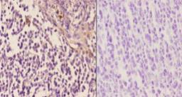 Immunohistochemistry-Paraffin: Arrestin 3 Antibody [NBP1-19629] - Analyzes of  paraffin-embedded human tonsil carcinoma tissue at 1:50.showing cytoplasmic and nucleus staining.  Negative control (the right) Using PBS instead of primary antibody.