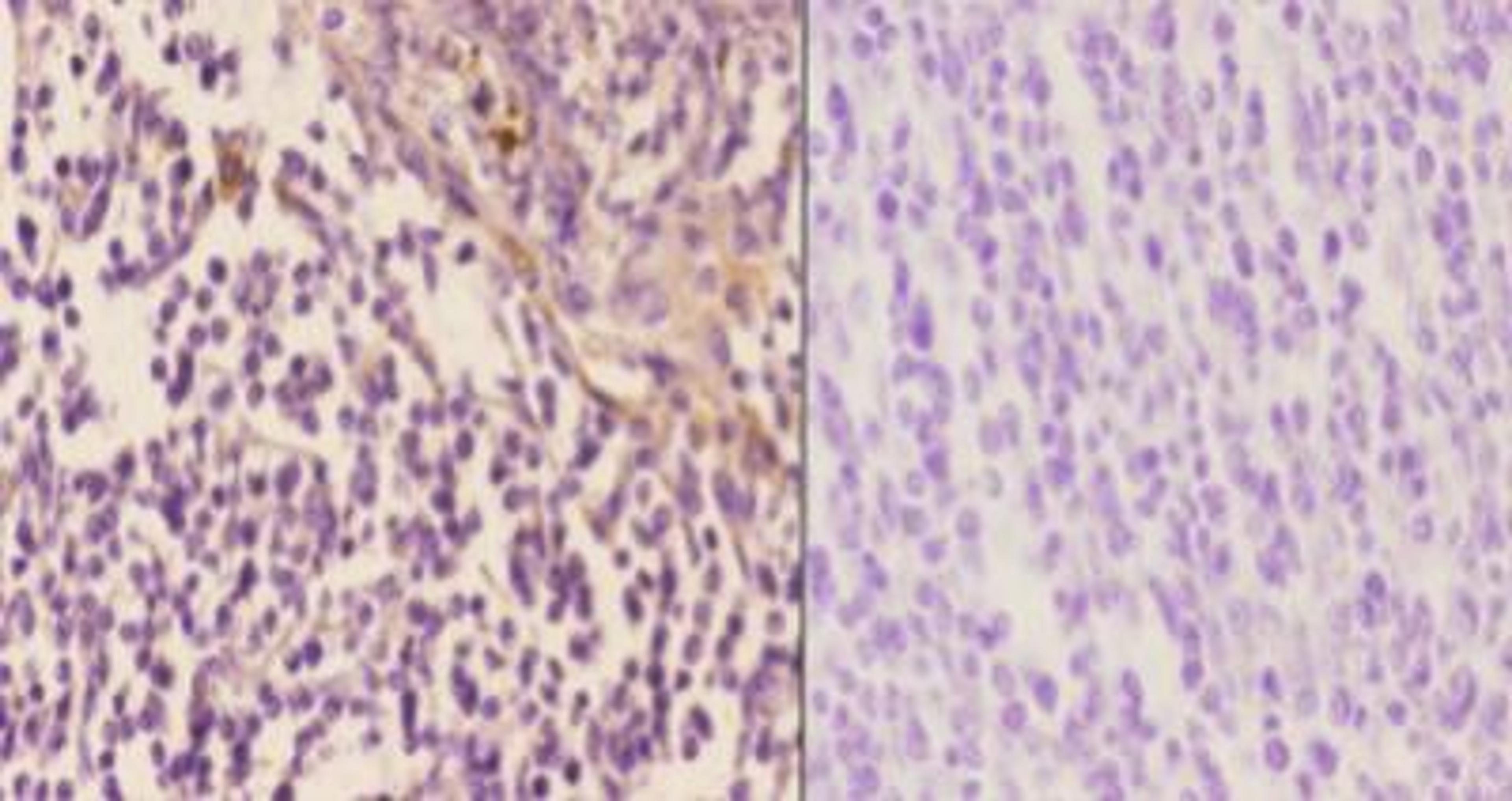 Immunohistochemistry-Paraffin: Arrestin 3 Antibody [NBP1-19629] - Analyzes of  paraffin-embedded human tonsil carcinoma tissue at 1:50.showing cytoplasmic and nucleus staining.  Negative control (the right) Using PBS instead of primary antibody.