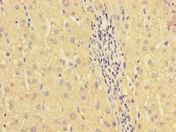 Immunohistochemistry of paraffin-embedded human liver cancer using CSB-PA010652LA01HU at dilution of 1:100