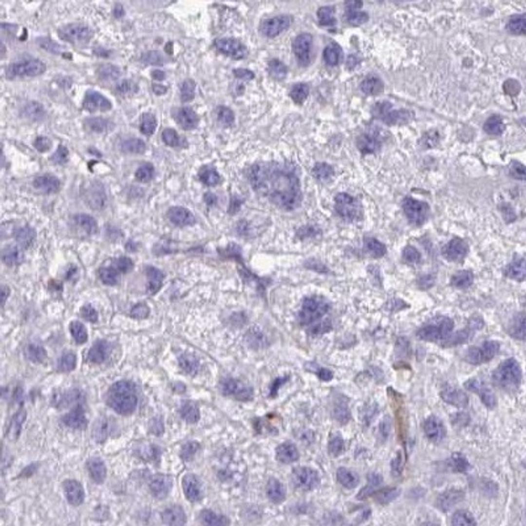 Immunohistochemistry: RNF89 Antibody [NBP2-31826] - liver cancer