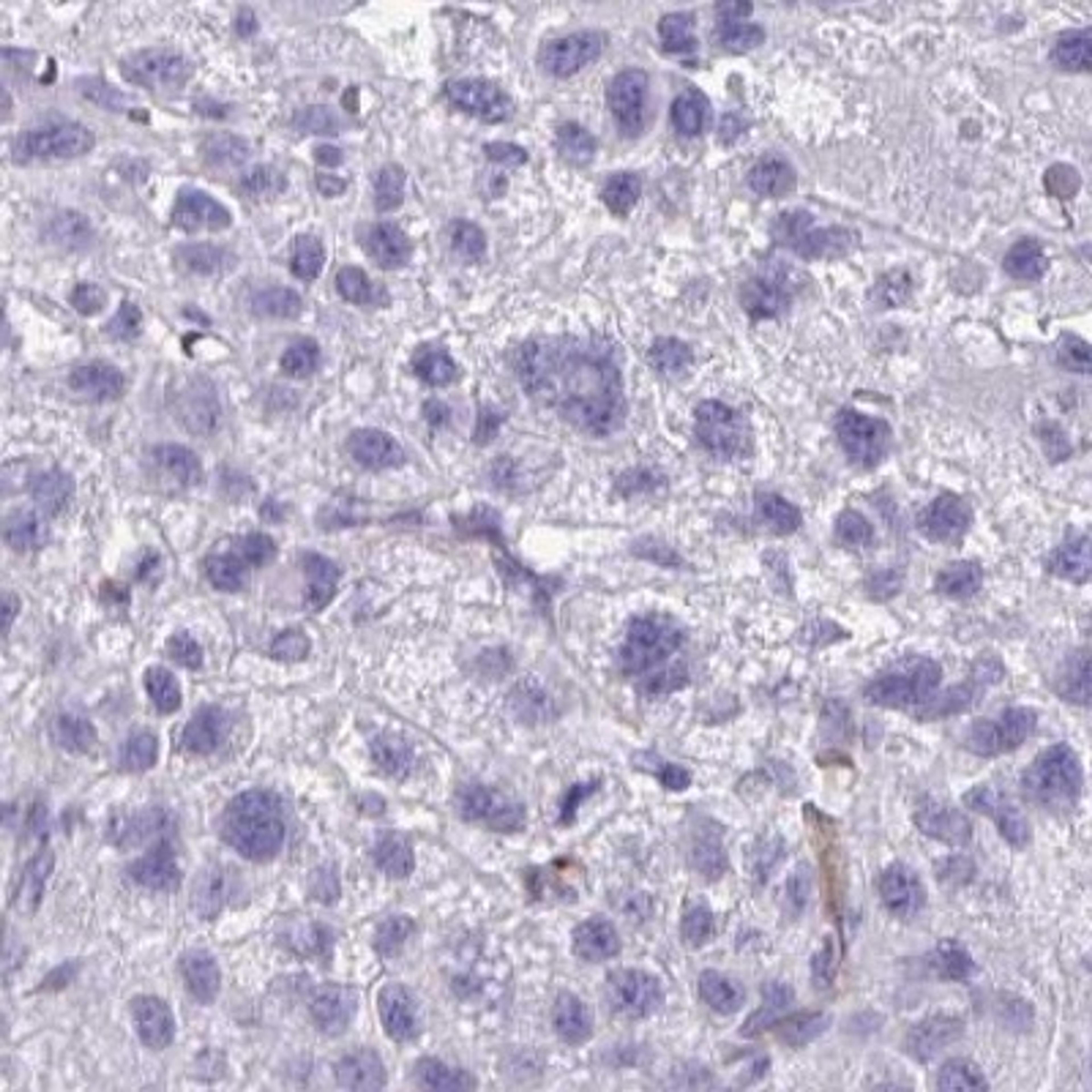 Immunohistochemistry: RNF89 Antibody [NBP2-31826] - liver cancer