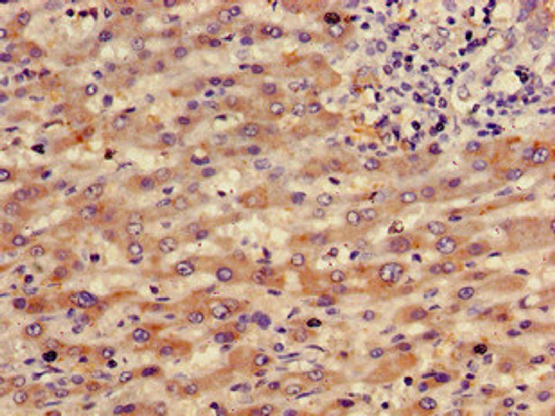 Immunohistochemistry of paraffin-embedded human liver cancer using CSB-PA019483YD01HU at dilution of 1:100