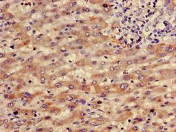 Immunohistochemistry of paraffin-embedded human liver cancer using CSB-PA019483YD01HU at dilution of 1:100