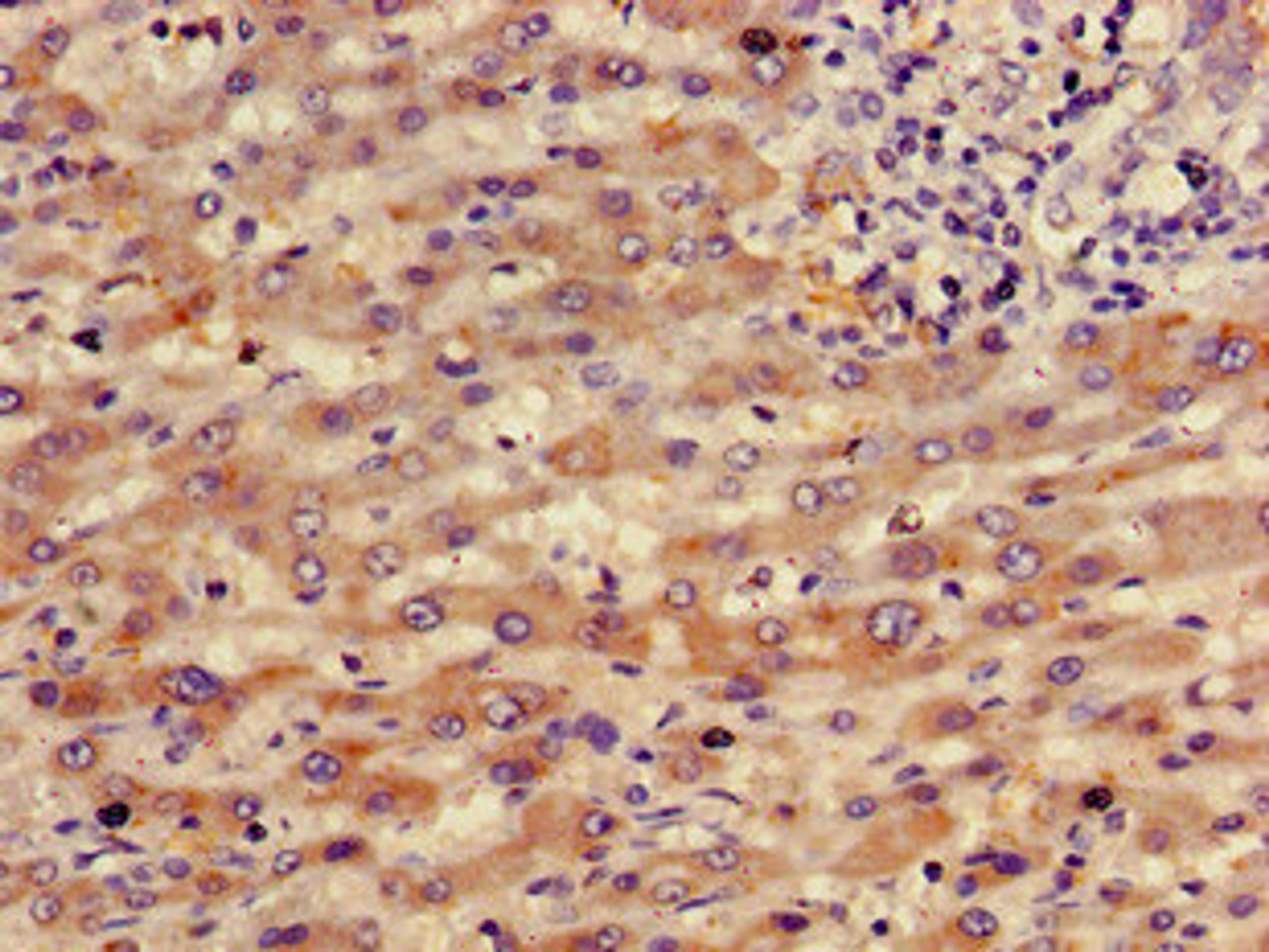 Immunohistochemistry of paraffin-embedded human liver cancer using CSB-PA019483YD01HU at dilution of 1:100