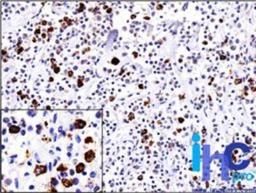 Immunohistochemistry-Paraffin: Lambda light chain Antibody (ICO106) [NBP2-29462] - Formalin-fixed, paraffin-embedded non-Hodgkin's lymphoma stained with Lambda antibody (1:200), peroxidase-conjugate and DAB chromogen. Note the cell membrane and cytoplasmic staining.