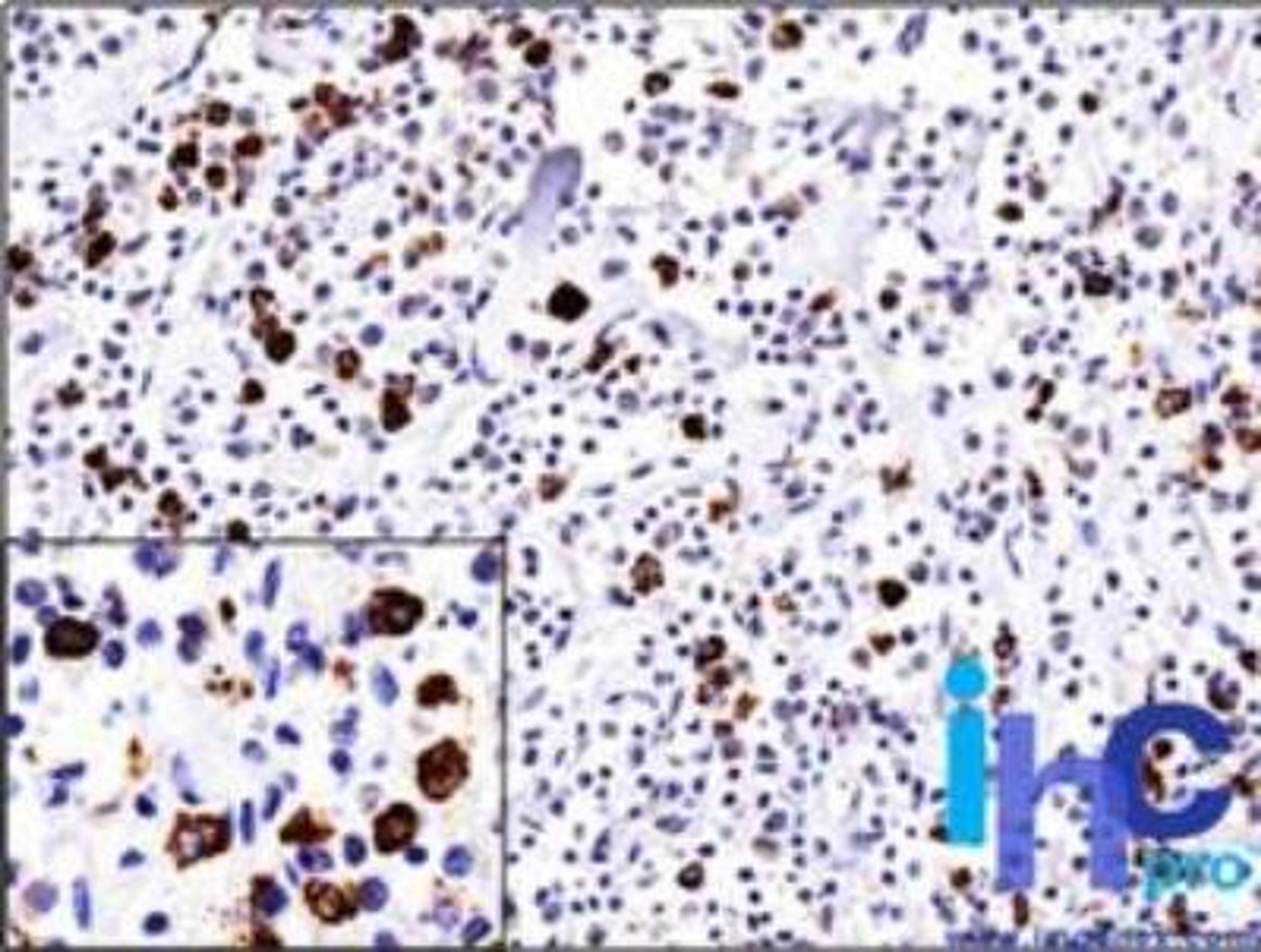 Immunohistochemistry-Paraffin: Lambda light chain Antibody (ICO106) [NBP2-29462] - Formalin-fixed, paraffin-embedded non-Hodgkin's lymphoma stained with Lambda antibody (1:200), peroxidase-conjugate and DAB chromogen. Note the cell membrane and cytoplasmic staining.