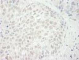 Immunohistochemistry-Paraffin: BRG1 Antibody [NB100-2594] - FFPE section of human non-small cell lung cancer.  Affinity purified rabbit anti-BRG1/SMARCA4 used at a dilution of 1:250.