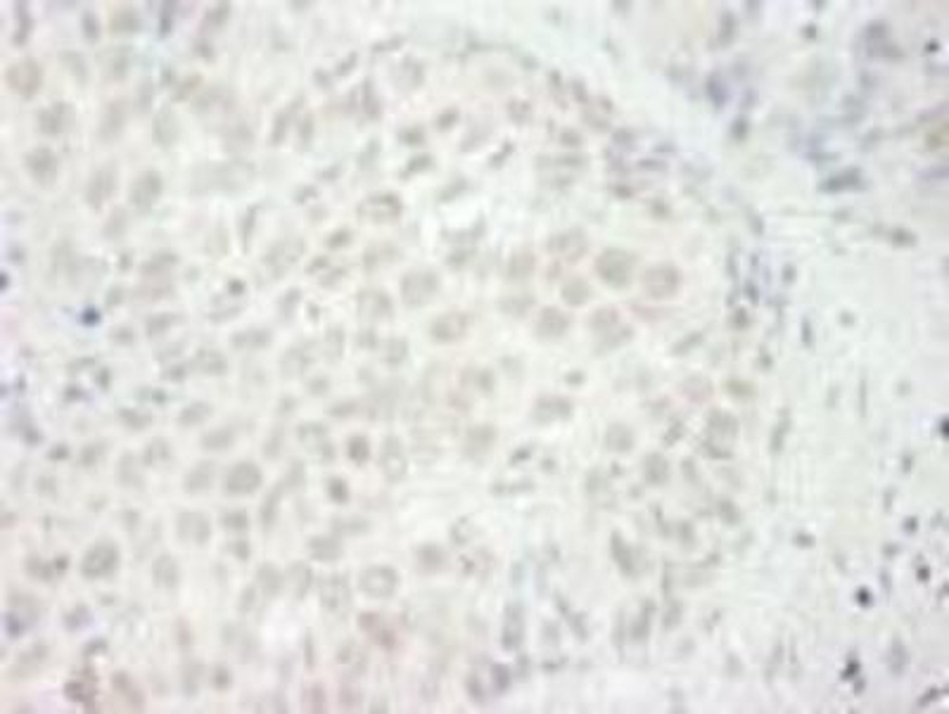 Immunohistochemistry-Paraffin: BRG1 Antibody [NB100-2594] - FFPE section of human non-small cell lung cancer.  Affinity purified rabbit anti-BRG1/SMARCA4 used at a dilution of 1:250.