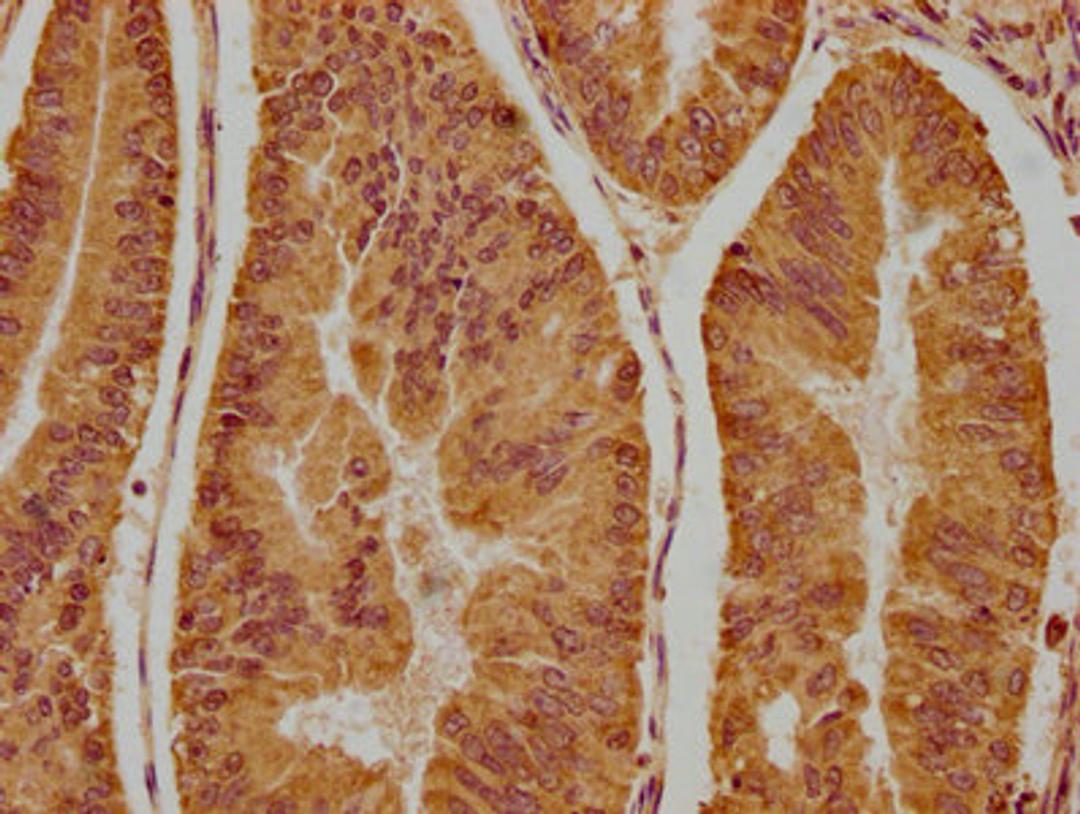 IHC image of CSB-PA856416LA01HU diluted at 1:300 and staining in paraffin-embedded human endometrial cancer performed on a Leica BondTM system. After dewaxing and hydration, antigen retrieval was mediated by high pressure in a citrate buffer (pH 6.0). Section was blocked with 10% normal goat serum 30min at RT. Then primary antibody (1% BSA) was incubated at 4°C overnight. The primary is detected by a biotinylated secondary antibody and visualized using an HRP conjugated SP system.