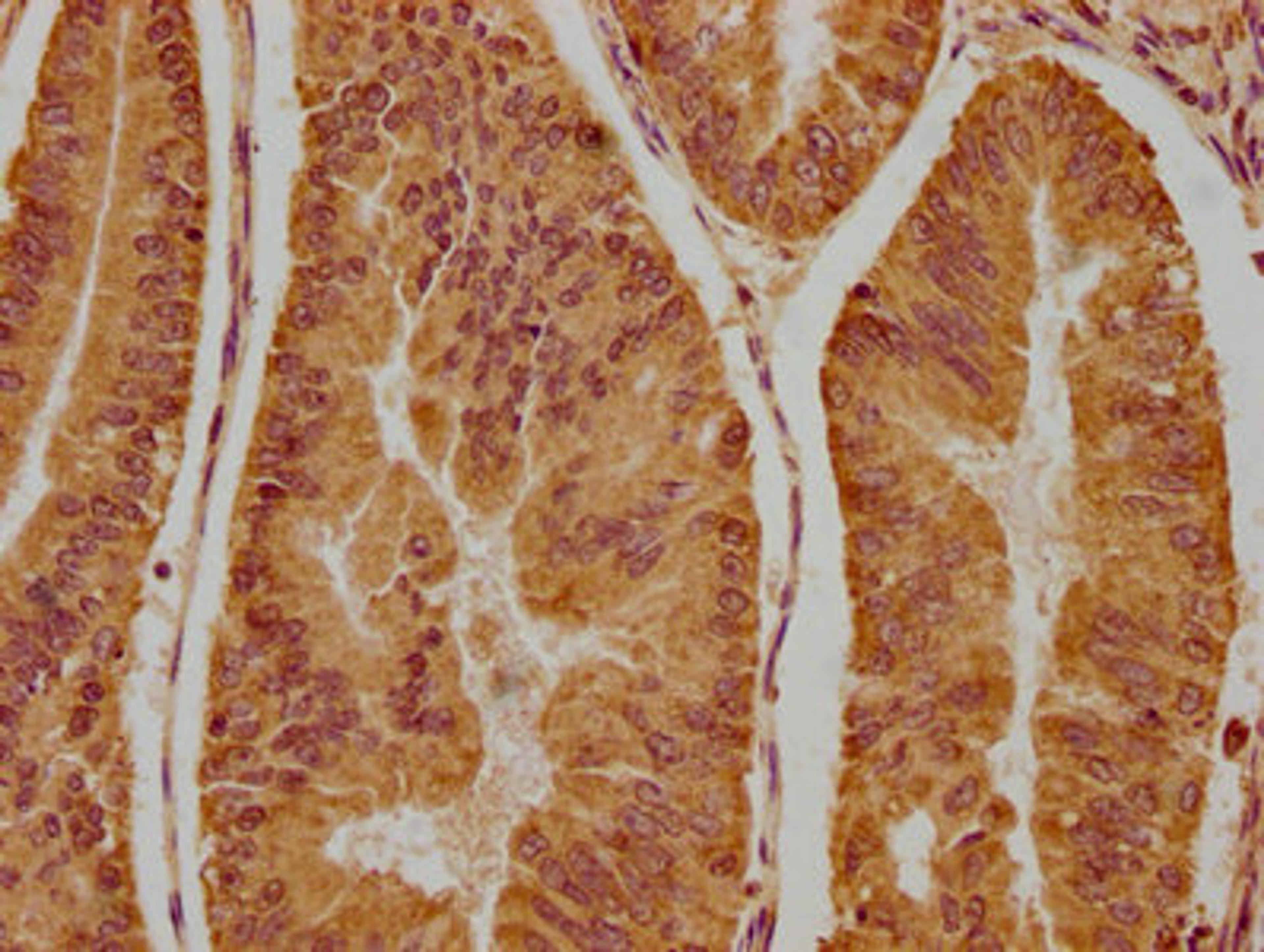 IHC image of CSB-PA856416LA01HU diluted at 1:300 and staining in paraffin-embedded human endometrial cancer performed on a Leica BondTM system. After dewaxing and hydration, antigen retrieval was mediated by high pressure in a citrate buffer (pH 6.0). Section was blocked with 10% normal goat serum 30min at RT. Then primary antibody (1% BSA) was incubated at 4°C overnight. The primary is detected by a biotinylated secondary antibody and visualized using an HRP conjugated SP system.