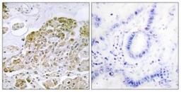 Immunohistochemistry-Paraffin: TFEB Antibody [NBP1-67872] - Analysis of paraffin-embedded human lung carcinoma tissue, using . The picture on the right is treated with the synthesized peptide.