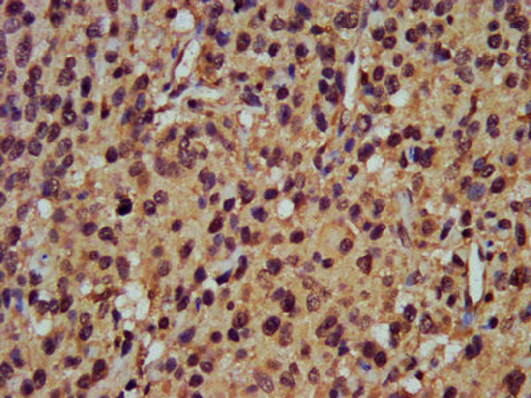 IHC image of CSB-PA018365LA01HU diluted at 1:400 and staining in paraffin-embedded human glioma performed on a Leica BondTM system. After dewaxing and hydration, antigen retrieval was mediated by high pressure in a citrate buffer (pH 6.0). Section was blocked with 10% normal goat serum 30min at RT. Then primary antibody (1% BSA) was incubated at 4°C overnight. The primary is detected by a biotinylated secondary antibody and visualized using an HRP conjugated SP system.