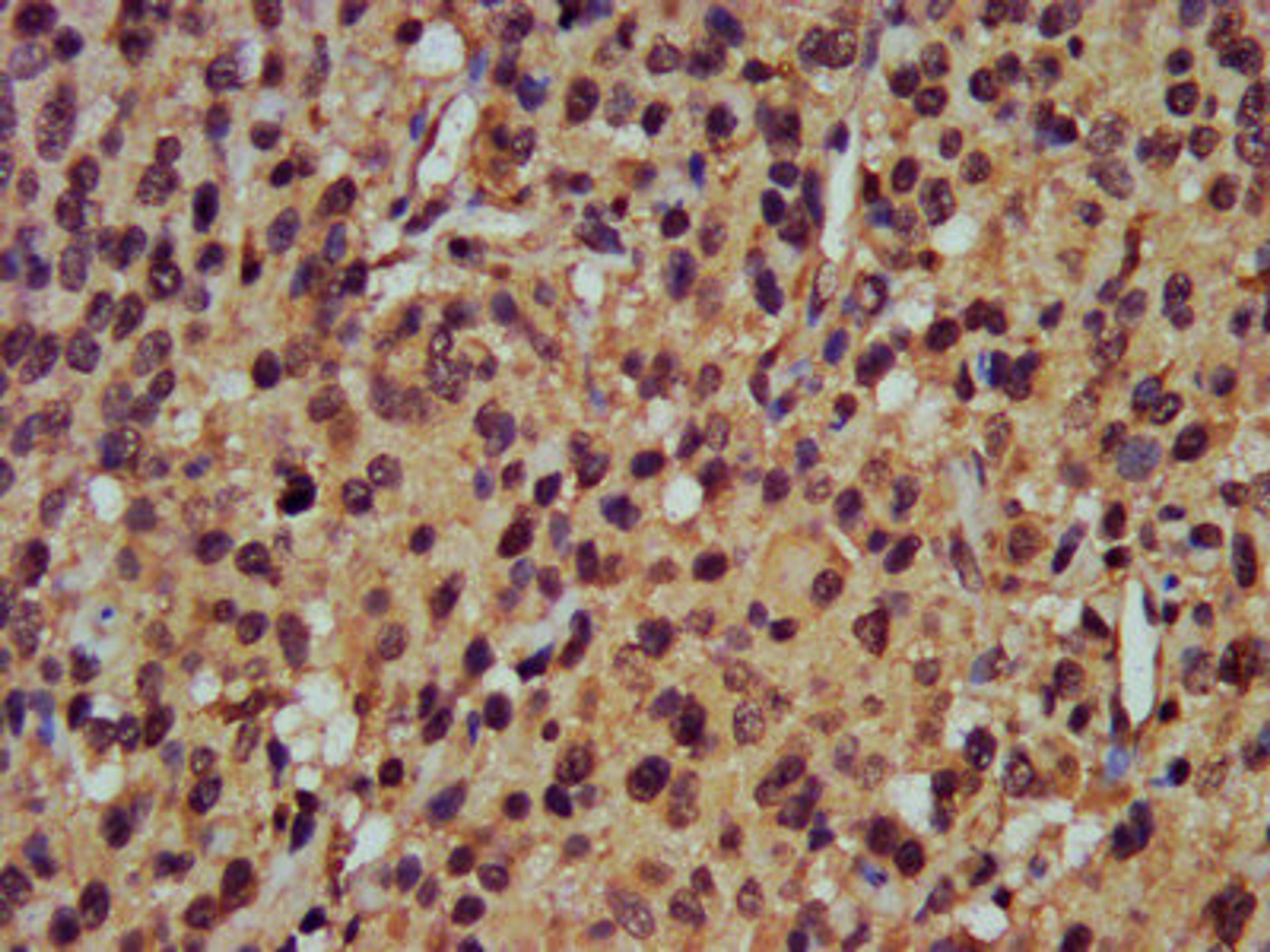 IHC image of CSB-PA018365LA01HU diluted at 1:400 and staining in paraffin-embedded human glioma performed on a Leica BondTM system. After dewaxing and hydration, antigen retrieval was mediated by high pressure in a citrate buffer (pH 6.0). Section was blocked with 10% normal goat serum 30min at RT. Then primary antibody (1% BSA) was incubated at 4°C overnight. The primary is detected by a biotinylated secondary antibody and visualized using an HRP conjugated SP system.