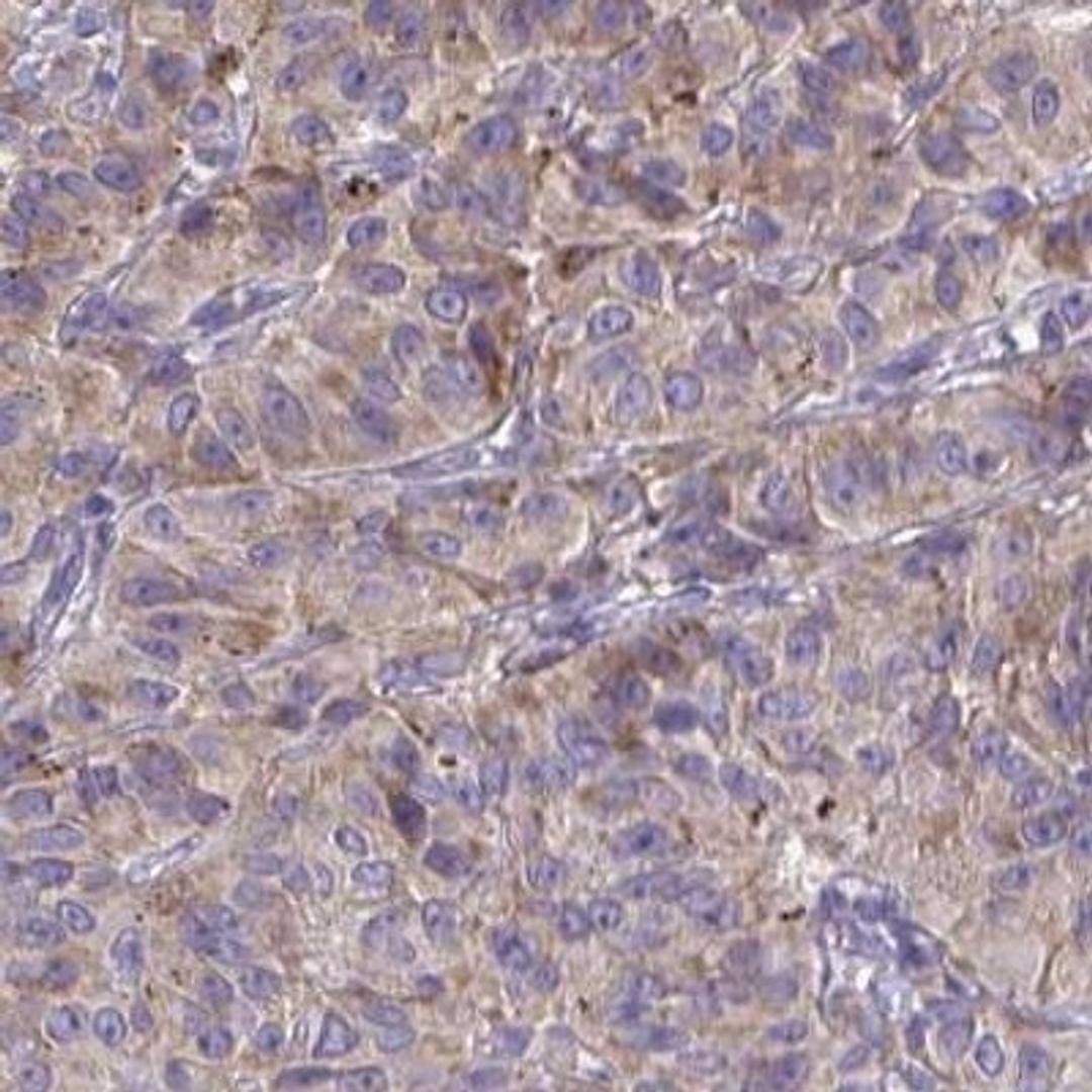 Immunohistochemistry: TMEM219 Antibody [NBP2-32439] - melanoma