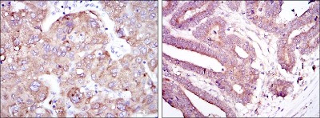 Immunohistochemistry: RBP4/Retinol-Binding Protein 4 Antibody (4C2) [NBP2-37614] - Immunohistochemical analysis of paraffin-embedded liver cancer tissues (left) and stomach cancer tissues (right) using RBP4 mouse mAb with DAB staining.