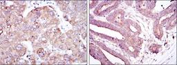 Immunohistochemistry: RBP4/Retinol-Binding Protein 4 Antibody (4C2) [NBP2-37614] - Immunohistochemical analysis of paraffin-embedded liver cancer tissues (left) and stomach cancer tissues (right) using RBP4 mouse mAb with DAB staining.