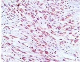 Immunohistochemistry-Paraffin: ORF73/HHV8 Antibody (4C11) [NBP1-30176] - IHC analysis of Kaposi's sarcoma tissue using antibody (1:50) for 2 hours at room temperature. Antigen retrieval was performed in 0.1M sodium citrate buffer and detected using Diaminobenzidine (DAB).