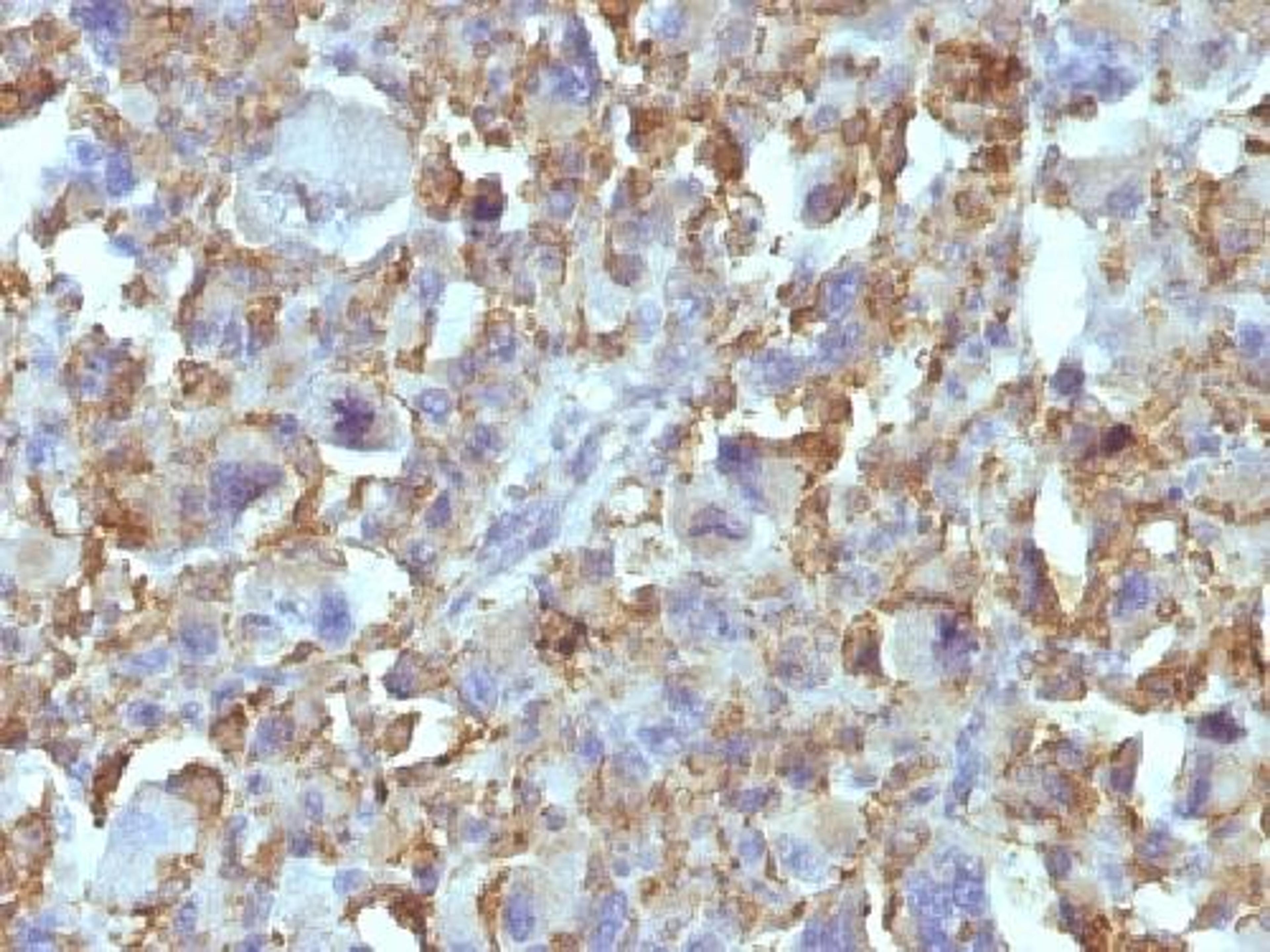 Immunohistochemical staining of human Histiocytoma tissue using Macrophage & Histiocytoma Marker antibody