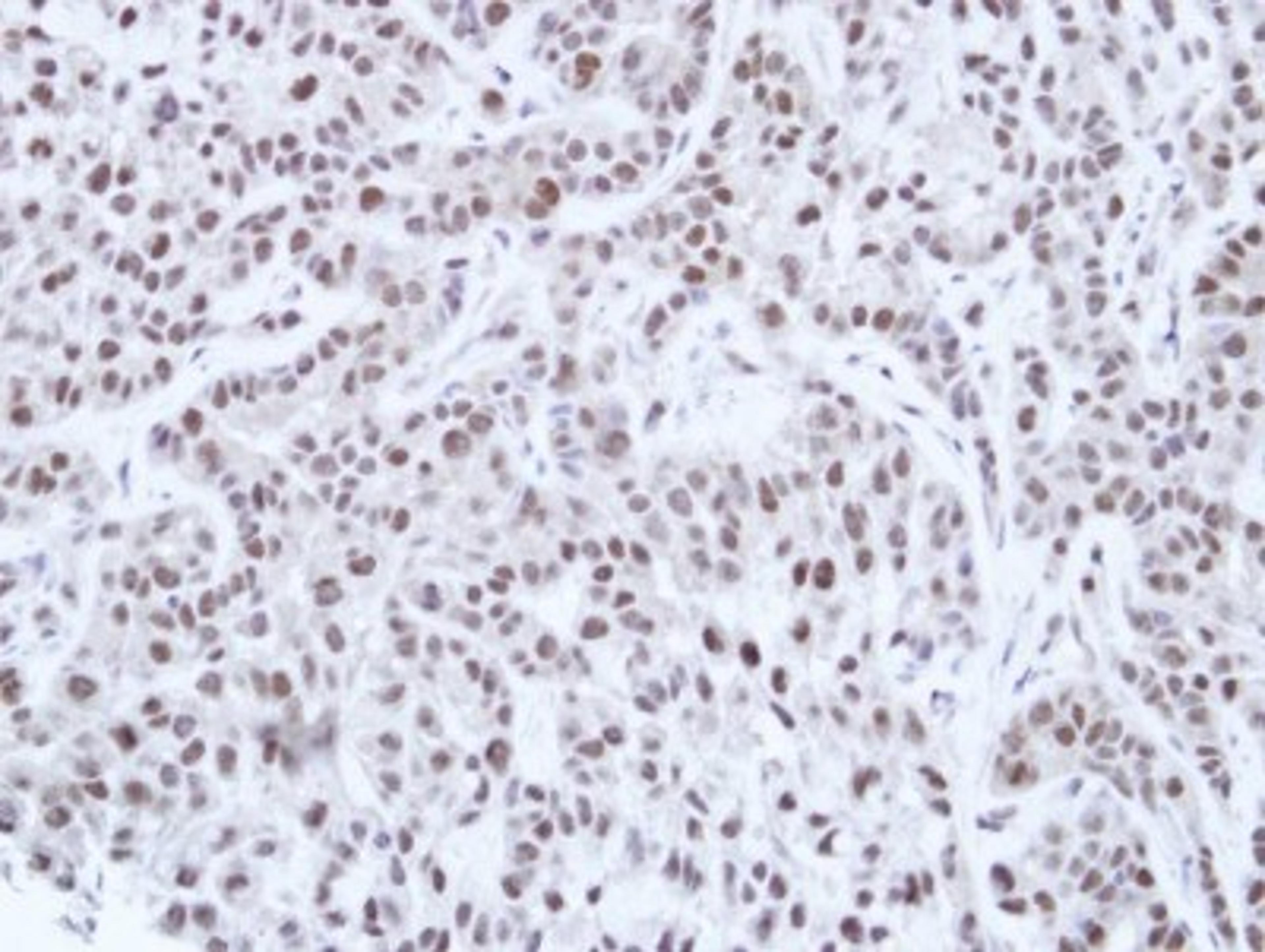 Immunohistochemistry-Paraffin: HNF1 Antibody [NBP1-33596] - Paraffin-embedded A549 Xenograft, using antibody at 1:100 dilution.