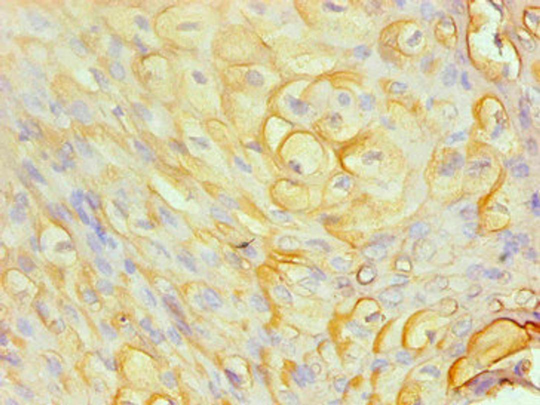 Immunohistochemical of paraffin-embedded human cervical cancer  using CSB-MA0206411A0m at dilution of 1:200