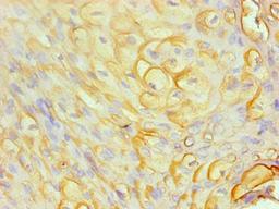 Immunohistochemical of paraffin-embedded human cervical cancer  using CSB-MA0206411A0m at dilution of 1:200
