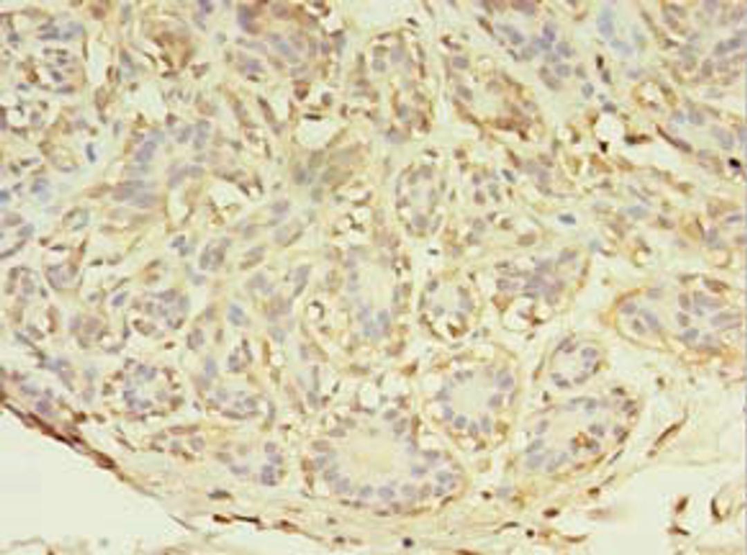 Immunohistochemistry of paraffin-embedded human breast cancer using CSB-PA874812LA01HU at dilution of 1:100