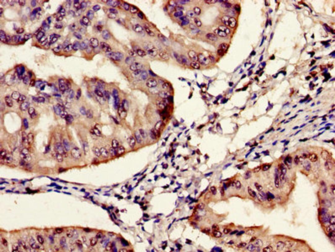Immunohistochemistry of paraffin-embedded human endometrial cancer using CSB-PA841001LA01HU at dilution of 1:100