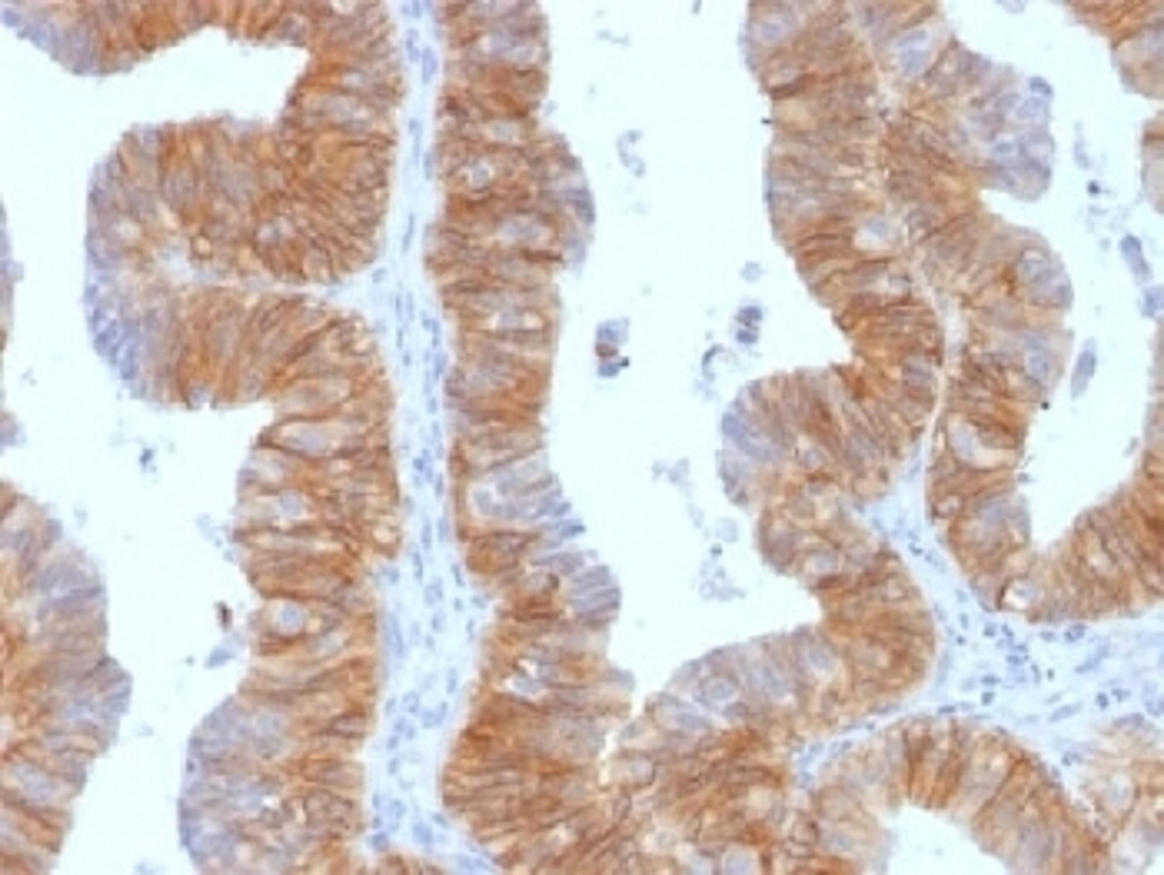 IHC testing of FFPE human ovarian carcinoma and EpCAM antibody (clone EGP40/1384). Required HIER: steam sections in pH6 citrate buffer for 10-20 min.