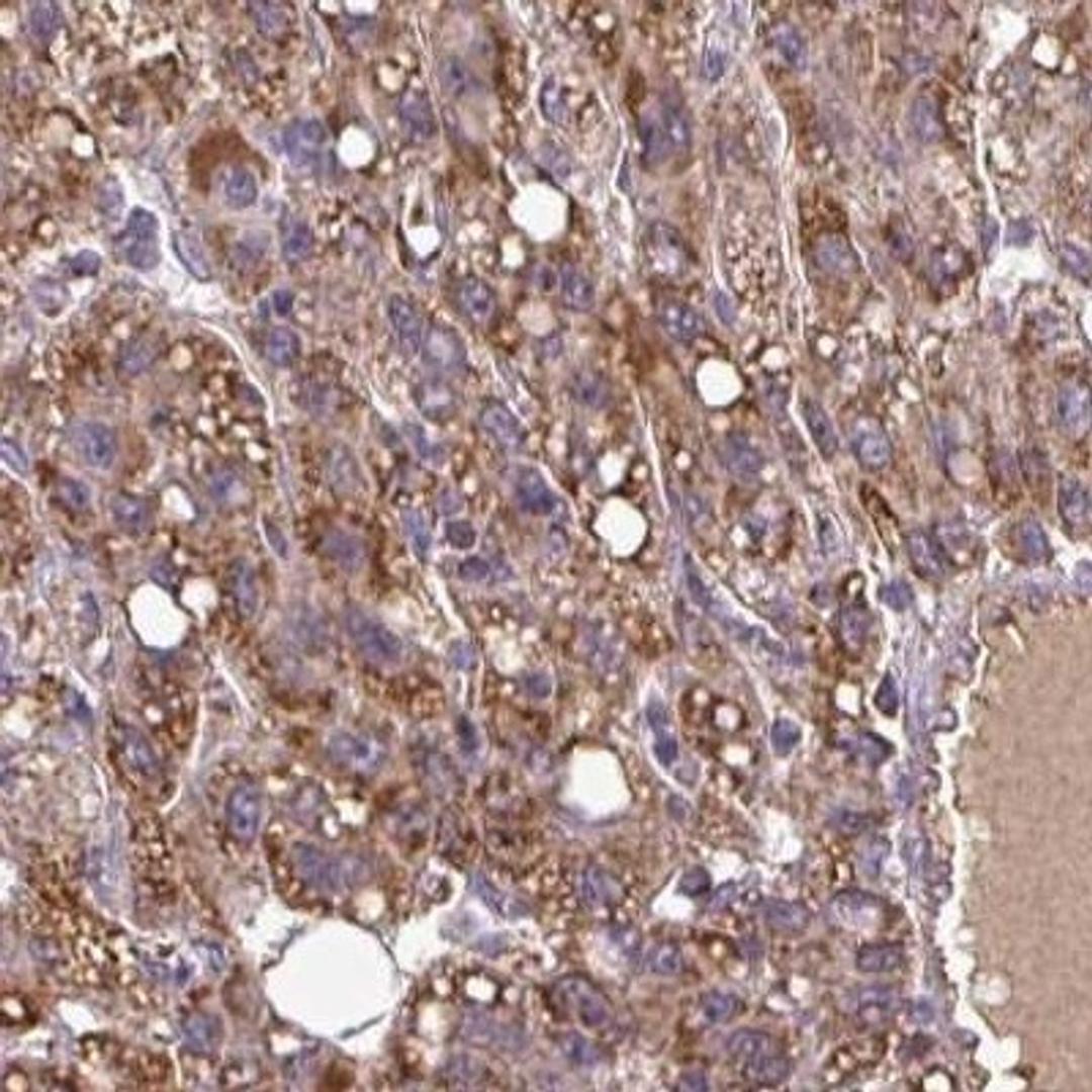 Immunohistochemistry-Paraffin: SLMO2 Antibody [NBP2-33497] - liver cancer