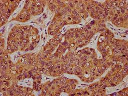 IHC image of CSB-PA22579A0Rb diluted at 1:200 and staining in paraffin-embedded human liver cancer performed on a Leica BondTM system. After dewaxing and hydration, antigen retrieval was mediated by high pressure in a citrate buffer (pH 6.0). Section was blocked with 10% normal goat serum 30min at RT. Then primary antibody (1% BSA) was incubated at 4°C overnight. The primary is detected by a biotinylated secondary antibody and visualized using an HRP conjugated SP system.