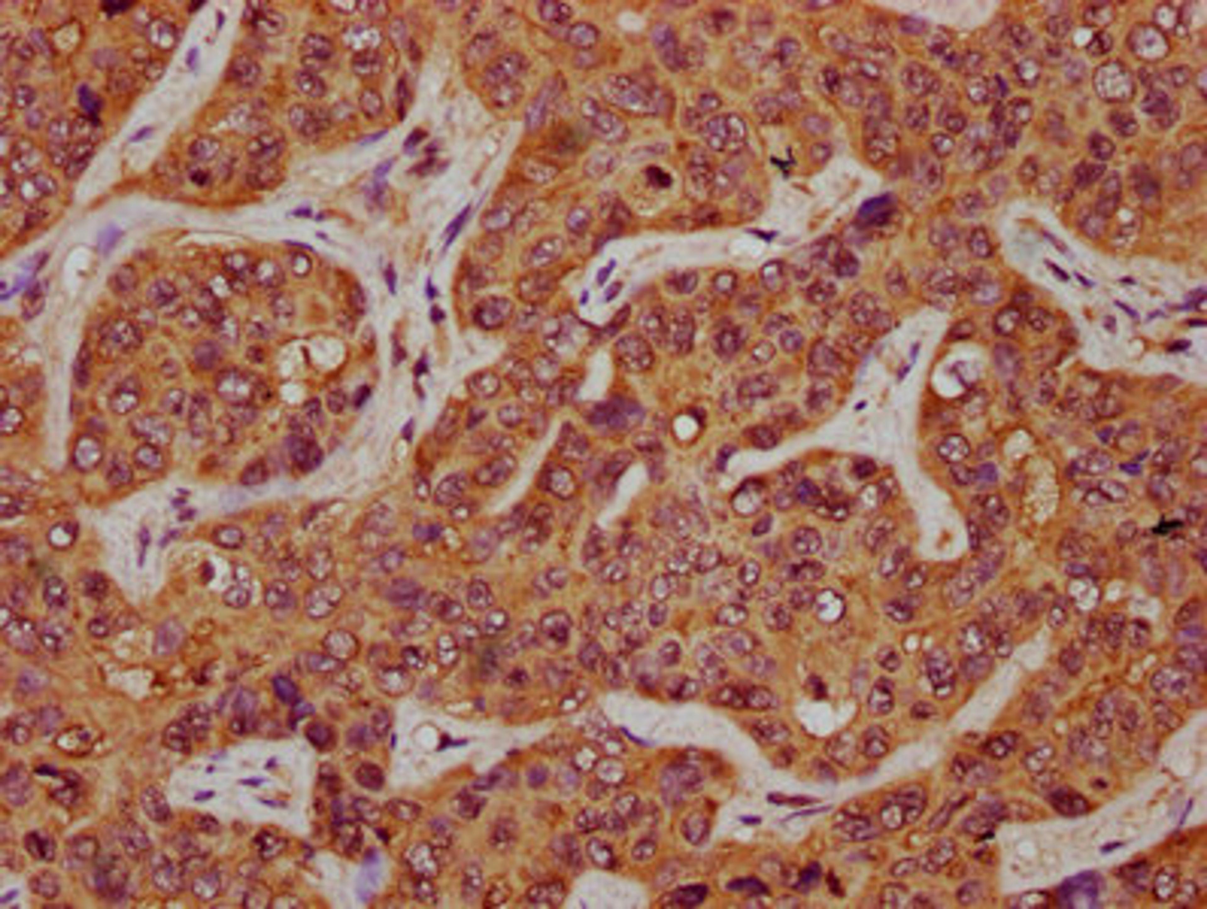 IHC image of CSB-PA22579A0Rb diluted at 1:200 and staining in paraffin-embedded human liver cancer performed on a Leica BondTM system. After dewaxing and hydration, antigen retrieval was mediated by high pressure in a citrate buffer (pH 6.0). Section was blocked with 10% normal goat serum 30min at RT. Then primary antibody (1% BSA) was incubated at 4°C overnight. The primary is detected by a biotinylated secondary antibody and visualized using an HRP conjugated SP system.