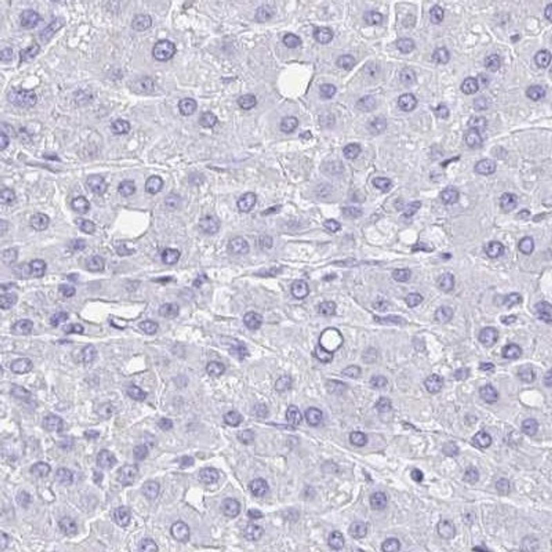 Immunohistochemistry: SELV Antibody [NBP2-32446] - liver cancer