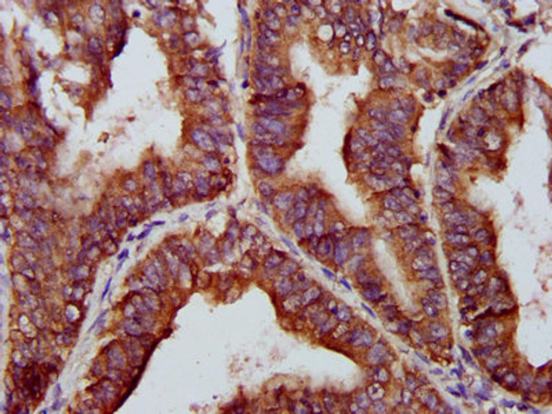 IHC image of CSB-PA873684LA01HU diluted at 1:200 and staining in paraffin-embedded human endometrial cancer performed on a Leica BondTM system. After dewaxing and hydration, antigen retrieval was mediated by high pressure in a citrate buffer (pH 6.0). Section was blocked with 10% normal goat serum 30min at RT. Then primary antibody (1% BSA) was incubated at 4&deg;C overnight. The primary is detected by a biotinylated secondary antibody and visualized using an HRP conjugated SP system.
