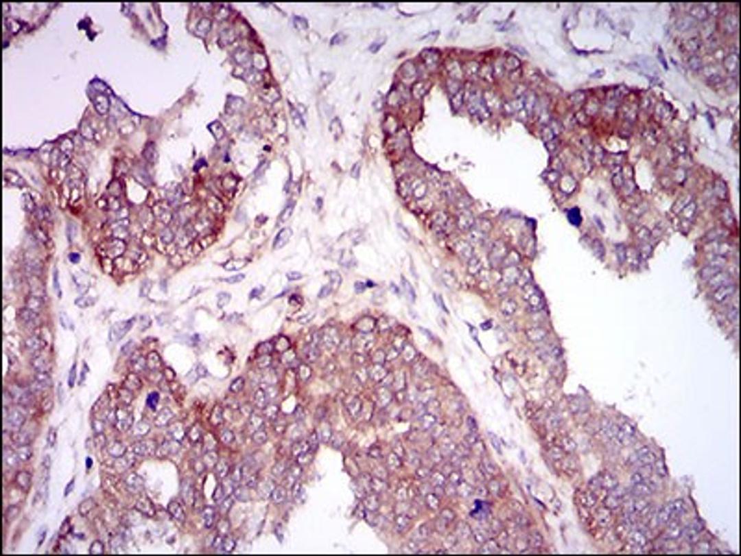 Immunohistochemistry: Hyaluronan synthase 2 Antibody (4E7) [NBP2-37446] - Immunohistochemical analysis of paraffin-embedded ovarian cancer tissues using HAS2 mouse mAb with DAB staining.