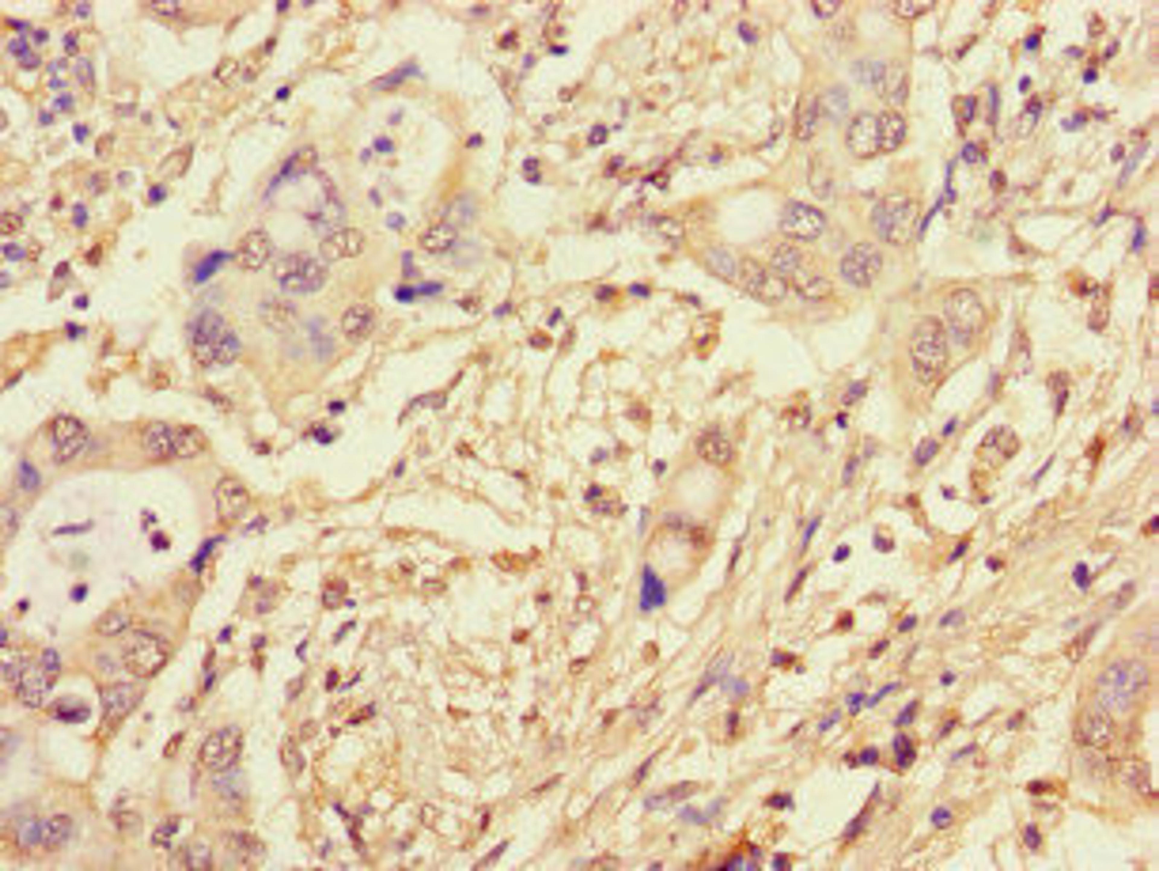 Immunohistochemistry of paraffin-embedded human pancreatic cancer using CSB-PA875721LA01HU at dilution of 1:100