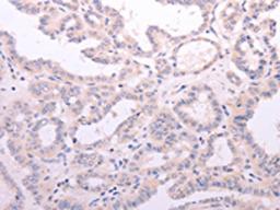 The image on the left is immunohistochemistry of paraffin-embedded Human thyroid cancer tissue using CSB-PA035040(ACOT2 Antibody) at dilution 1/15, on the right is treated with fusion protein. (Original magnification: ×200)