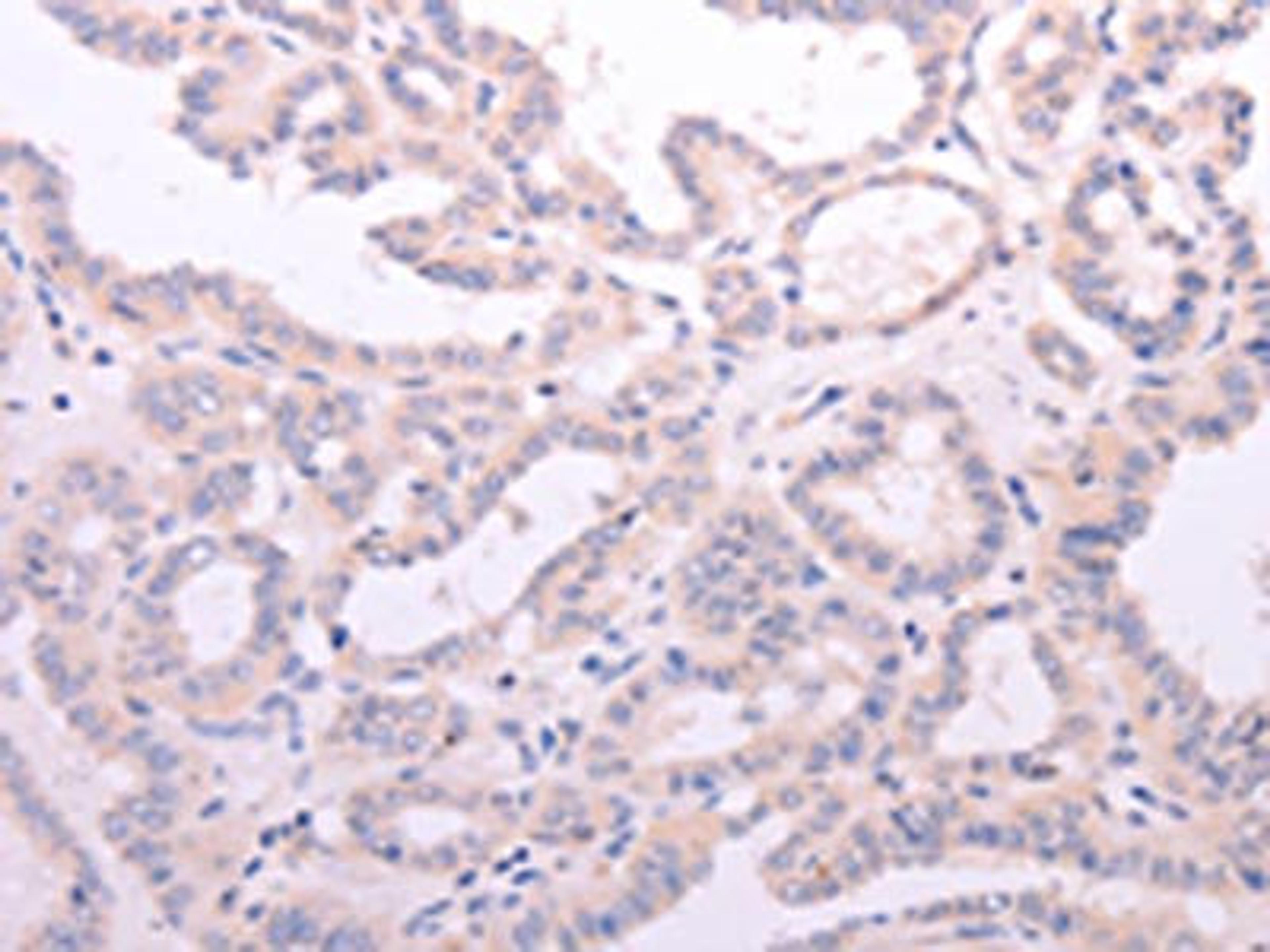 The image on the left is immunohistochemistry of paraffin-embedded Human thyroid cancer tissue using CSB-PA035040(ACOT2 Antibody) at dilution 1/15, on the right is treated with fusion protein. (Original magnification: ×200)